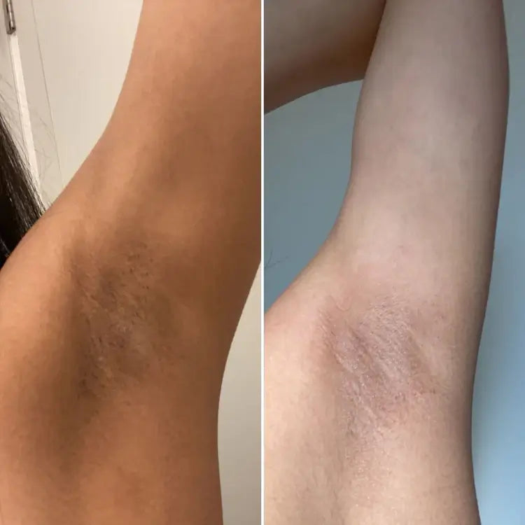 El Peeling Profesional de Ácido Hipocloroso